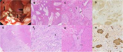 A Case Series of Pediatric Intestinal Ganglioneuromatosis With Novel Phenotypic and Genotypic Profile